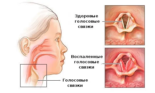 Порушення голосу - причини появи симптому, способи лікування