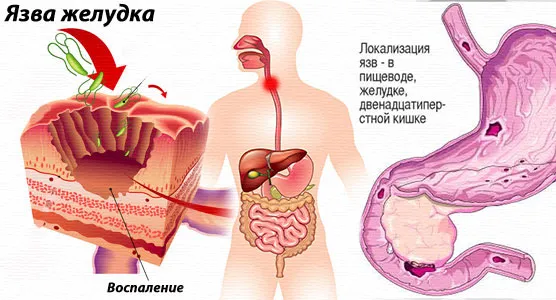 Народне лікування виразки стравоходу (окропу ложка насіння) Народне лікування виразки стравоходу