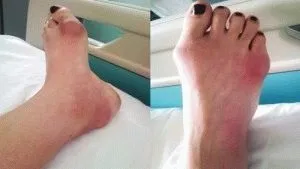 Болять суглоби пальців ніг що це може бути і як лікувати (болять) Болять суглоби пальців ніг що це може бути і як лікувати