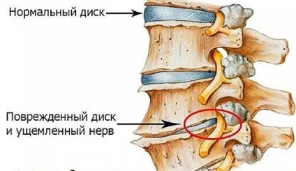Біль в грудині посередині - в чому причини, що робити (робити) Біль в грудині посередині - в чому причини, що робити