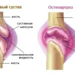 Остеоартроз лікування, симптоми, ознаки, профілактика (лікування) Остеоартроз лікування, симптоми, ознаки, профілактика