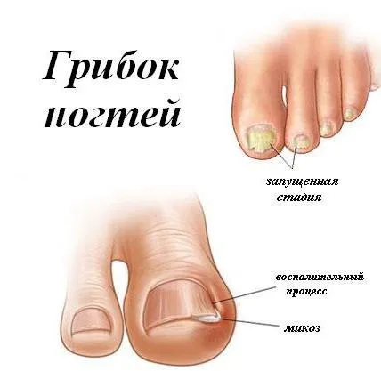 оніхомікоз нігтів