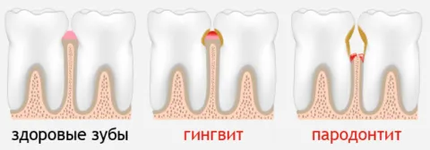 Опухла ясна близько зуба що робити для ефективного вирішення проблеми (опухла ясна близько зуба що робити) Опухла ясна близько зуба що робити для ефективного вирішення проблеми