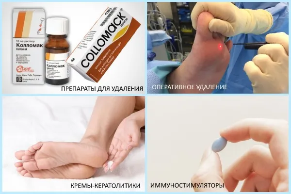 Від чого з'являються бородавки на ногах, чому причини появи (ногах) Від чого з'являються бородавки на ногах, чому причини появи
