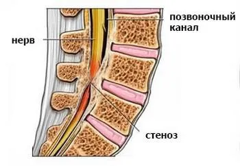 Патології, при яких болить шия з правого боку (болить) Патології, при яких болить шия з правого боку