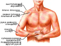 Перелом плечового суглоба види, симптоми, лікування і прогноз