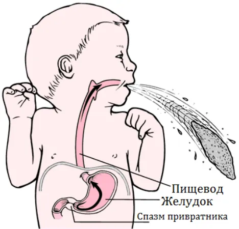 Пілороспазм у дітей і дорослих причини виникнення, симптоми, діагностика та лікування (дорослих) Пілороспазм у дітей і дорослих причини виникнення, симптоми, діагностика та лікування