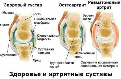 Чому болять суглоби рук в кистях і пальцях лікування і причини (кистях) Чому болять суглоби рук в кистях і пальцях лікування і причини