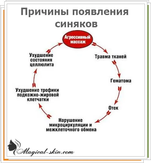 Після антицелюлітного масажу синці добре або погано (масажу) Після антицелюлітного масажу синці добре або погано