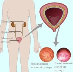Профілактика циститу методики, ліки і народні засоби (ліки) Профілактика циститу методики, ліки і народні засоби