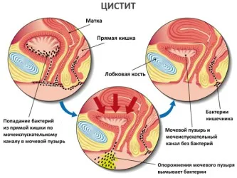 Профілактика циститу методики, ліки і народні засоби (циститу) Профілактика циститу методики, ліки і народні засоби