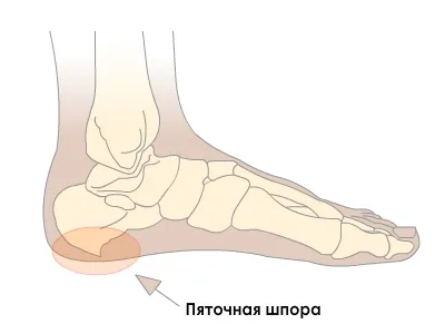 П'яткова шпора причини, симптоми і лікування