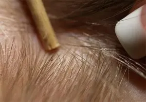Чим відрізняються воші від бліх подібності та відмінності