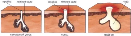 Чим відрізняються вугри від прищів класифікація, ступеня тяжкості, особливості лікування, фото (вугри) Чим відрізняються вугри від прищів класифікація, ступеня тяжкості, особливості лікування, фото