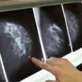 Шишка в грудній залозі у жінок що це може бути, причини, методи лікування