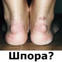 Шишка в грудині у жінок і чоловіків що це за ущільнення, чому болить (чоловіків) Шишка в грудині у жінок і чоловіків що це за ущільнення, чому болить