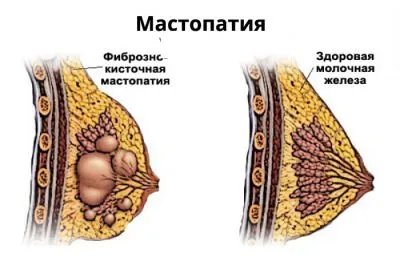 Шишка в грудині у жінок і чоловіків що це за ущільнення, чому болить (грудині) Шишка в грудині у жінок і чоловіків що це за ущільнення, чому болить
