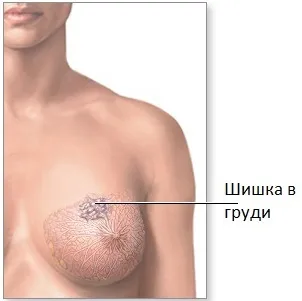 Шишка в грудній залозі у жінок норма чи небезпека для грудей (жінок) Шишка в грудній залозі у жінок норма чи небезпека для грудей