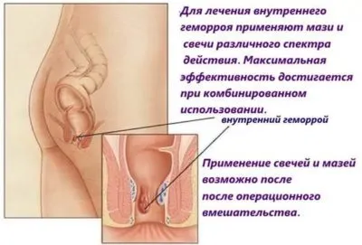 Скільки лікується геморой і як довго він проходить (лікується) Скільки лікується геморой і як довго він проходить