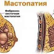 Трави при фіброзно кістозної мастопатії (фіброзно) Трави при фіброзно кістозної мастопатії