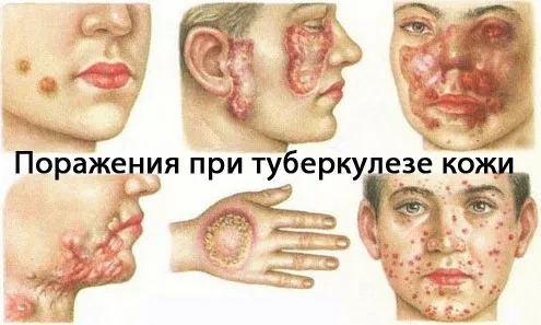 Туберкульоз шкіри причини, форми, симптоми і лікування (туберкульоз) Туберкульоз шкіри причини, форми, симптоми і лікування