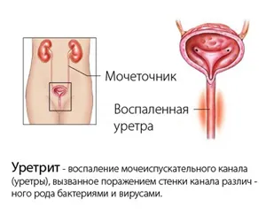 урологічні інфекції