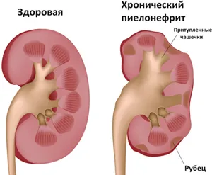 урологічні інфекції