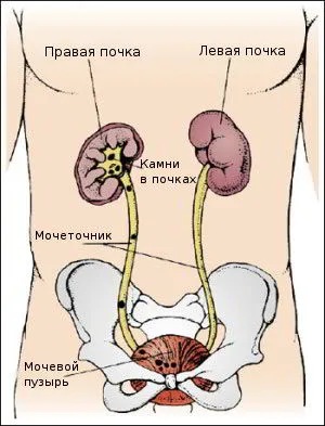 Уретеропіелокалікоектазія що це таке (таке) Уретеропіелокалікоектазія що це таке