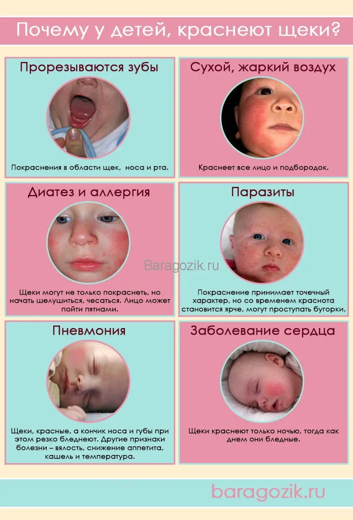 У дитини почервоніли щоки чому і як лікуватися при почервонінні (безпечна) У дитини почервоніли щоки чому і як лікуватися при почервонінні