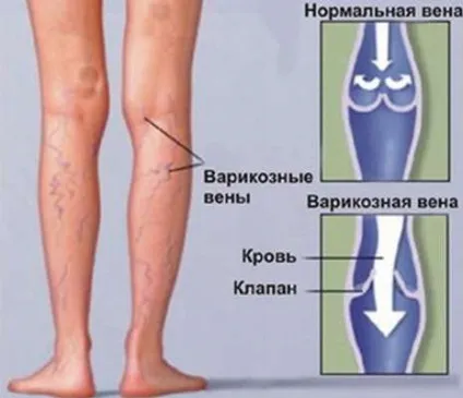 Чорніють ноги нижче колін - чому і що робити - відео - «все до дрібниць» (робити) Чорніють ноги нижче колін - чому і що робити - відео - «все до дрібниць»
