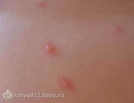 Вітрянка або алергія - на