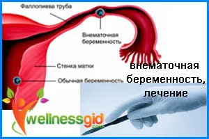 Позаматкова вагітність лікування (позаматкова вагітність як визначити) Позаматкова вагітність лікування