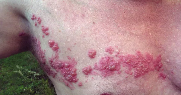 Вірус герпесу - неймовірно, які небезпеки приховує в собі цей вірус (вірус) Вірус герпесу - неймовірно, які небезпеки приховує в собі цей вірус
