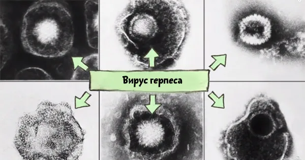 вірус герпесу