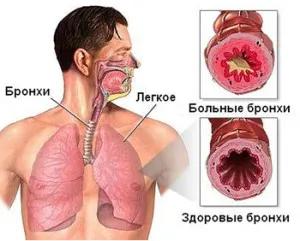 запалення бронхів
