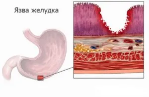 Хронічна виразка шлунка - симптоми, причини, дієта, лікування