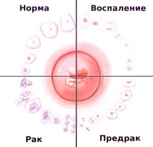 Аденокарцинома матки симптоми, причини, ефективне лікування (матки) Аденокарцинома матки симптоми, причини, ефективне лікування