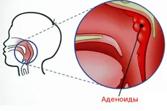 Адгезивний отит - симптоми та лікування народними засобами (народними) Адгезивний отит - симптоми і лікування народними засобами