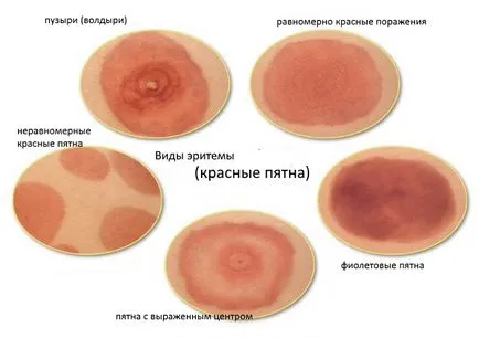 Алергія на бджіл