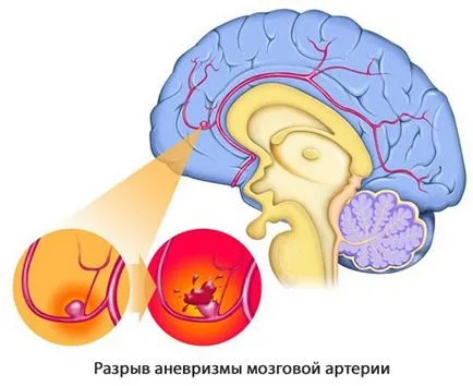 Аневризма у дітей - симптоми хвороби, профілактика і лікування аневризми у дітей, причини захворювання (лікування аневризми у дітей) Аневризма у дітей - симптоми хвороби, профілактика і лікування аневризми у дітей, причини захворювання