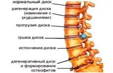 Що можна і що не можна робити при міжхребцевої грижі (можна) Що можна і що не можна робити при міжхребцевої грижі
