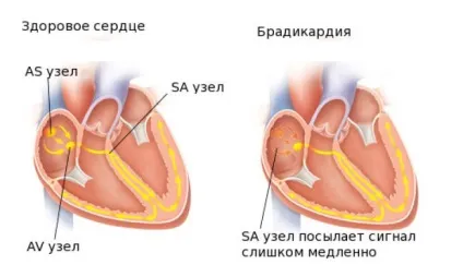 Що робити при брадикардії в домашніх умовах ніж лікувати (робити) Що робити при брадикардії в домашніх умовах ніж лікувати