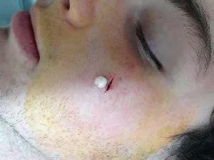 Атерома у дитини і новонародженого (дитини) Атерома у дитини і новонародженого