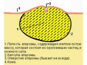 Атерома у дитини причини і лікування (причини) Атерома у дитини причини і лікування