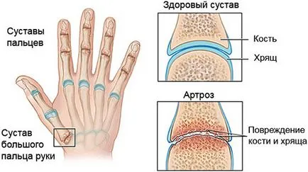 Артроз пальців рук симптоми і лікування кисті і великого пальця руки (кисті) Артроз пальців рук симптоми і лікування кисті і великого пальця руки