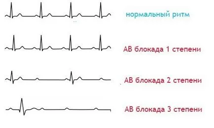 Атріовентрикулярна блокада симптоми і лікування (атріовентрикулярна) Атріовентрикулярна блокада симптоми і лікування