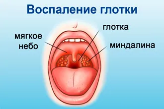 Бактеріальний фарингіт - симптоми і лікування у дітей та дорослих