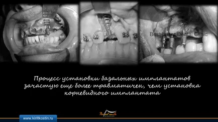 базальна імплантація