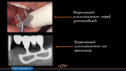 базальна імплантація