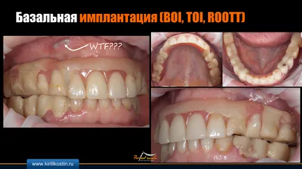 базальна імплантація